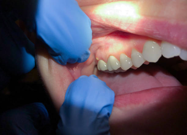 Best Dentist for Tooth Abscess  in East Shoreham, NY